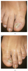 <p>Toenails, Onychogryphosis and Malalignment