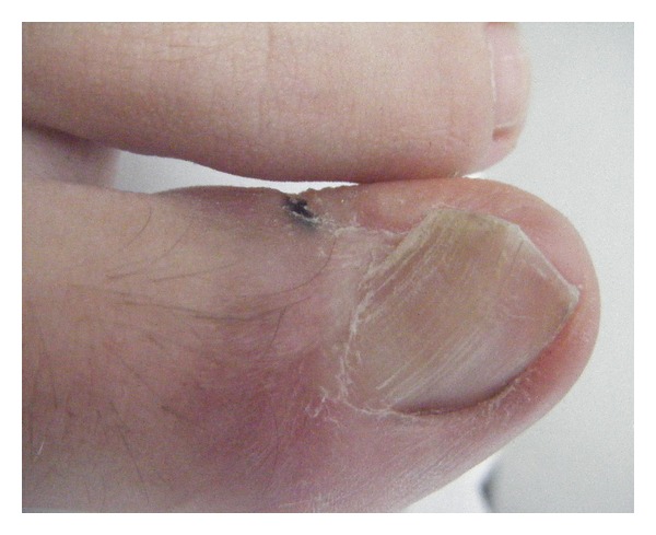 <p>Ingrown Toenail, Necrosis