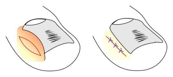 <p>Fusiform Excision. Schematic illustration of the reduction of a hypertrophic lateral nail fold by a fusiform excision.</p>