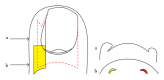 <p>Matrix Horn Resection. The schematic illustrates a selective lateral matrix horn resection.</p>