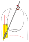 <p>Phenolization, Lateral Matrix Horn
