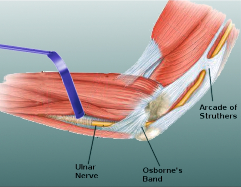 <p>Osborne Ligament in the Cubital Tunnel