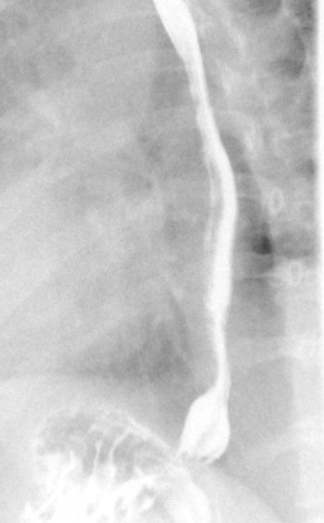 <p>Type I Hiatal Hernia