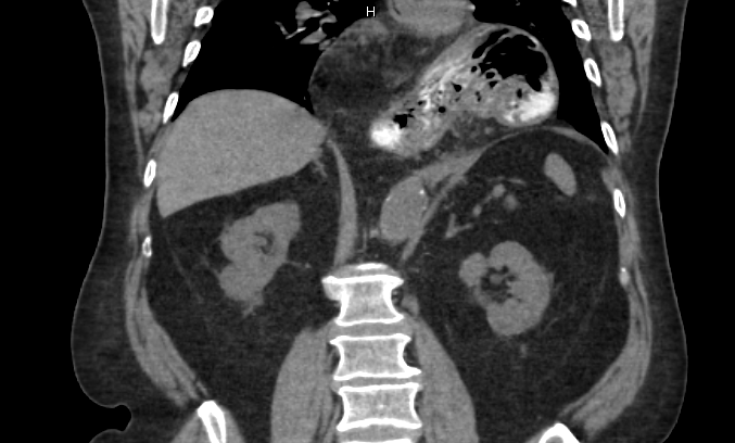 <p>Type III Paraesophageal Hernia on Computed Tomography