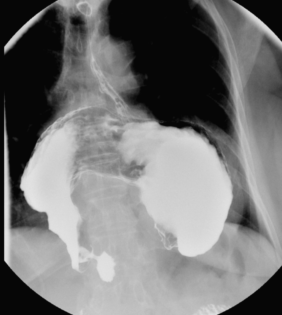<p>Gastric Volvulus on Contrast Radiography