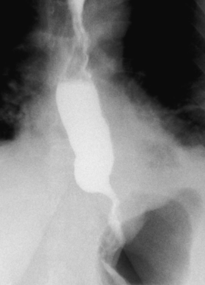 <p>Paraesophageal Hernia Esophagram