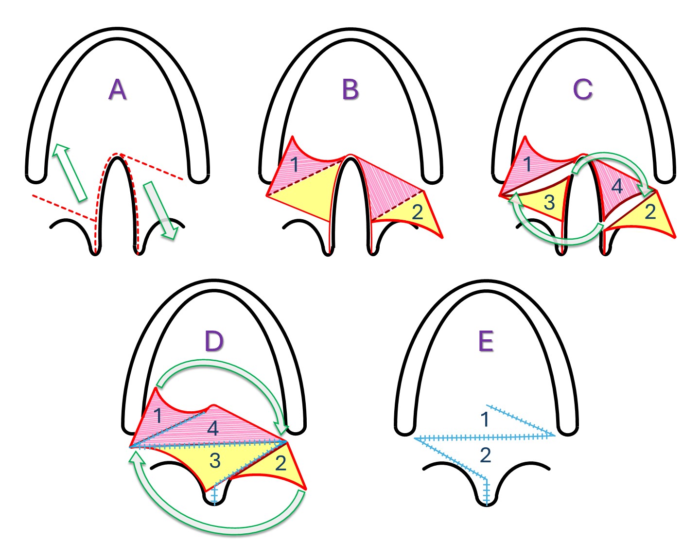 <p>Furlow &ldquo;Double-Opposing Z-Plasty