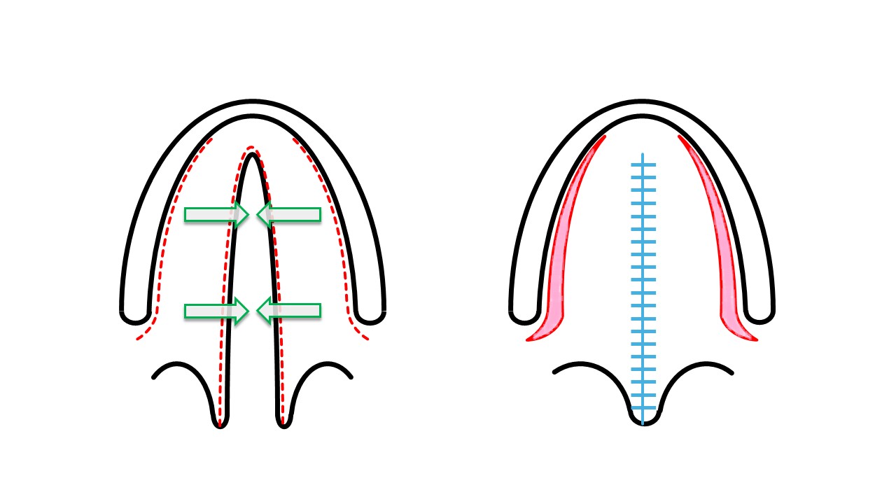 <p>Von Langenbeck Cleft Palate Repair