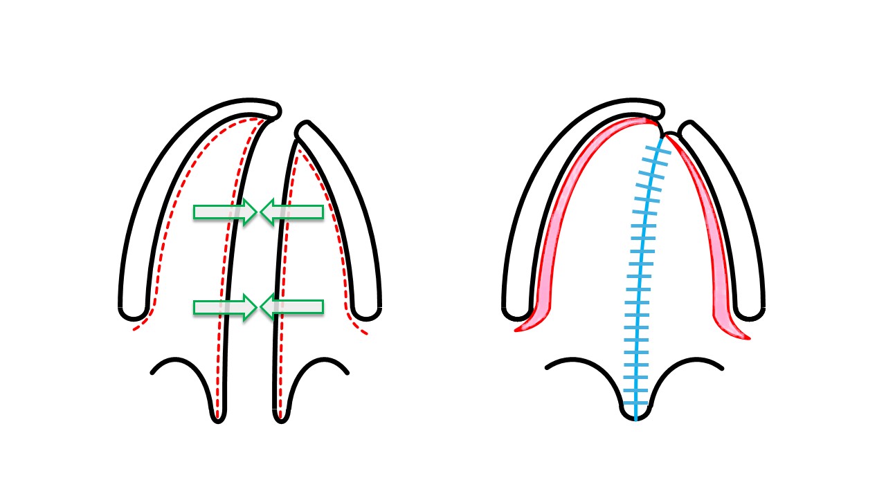 <p>Bardach Cleft Palate Repair