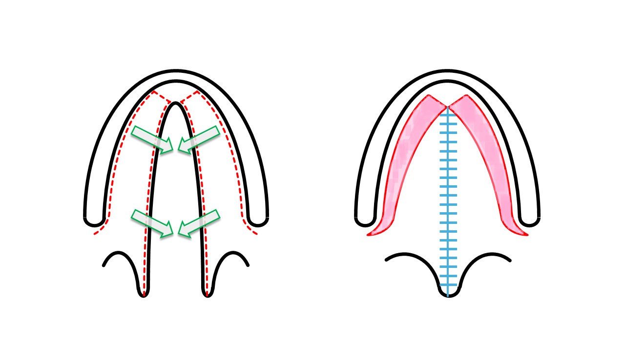 <p>Veau-Wardill-Kilner &ldquo;V-to-Y Pushback&rdquo; Cleft Palate Repair