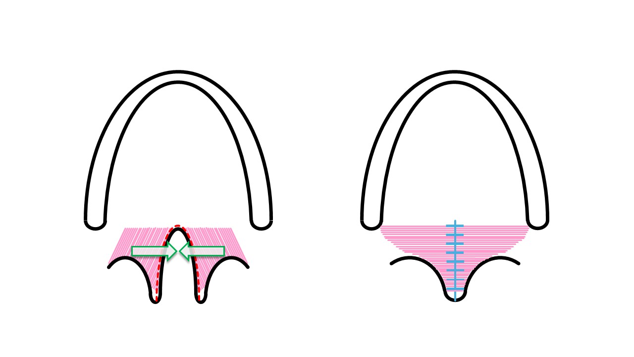 <p>Sommerlad Repair of Soft Palate Clefts and Muscular Sling Reconstruction