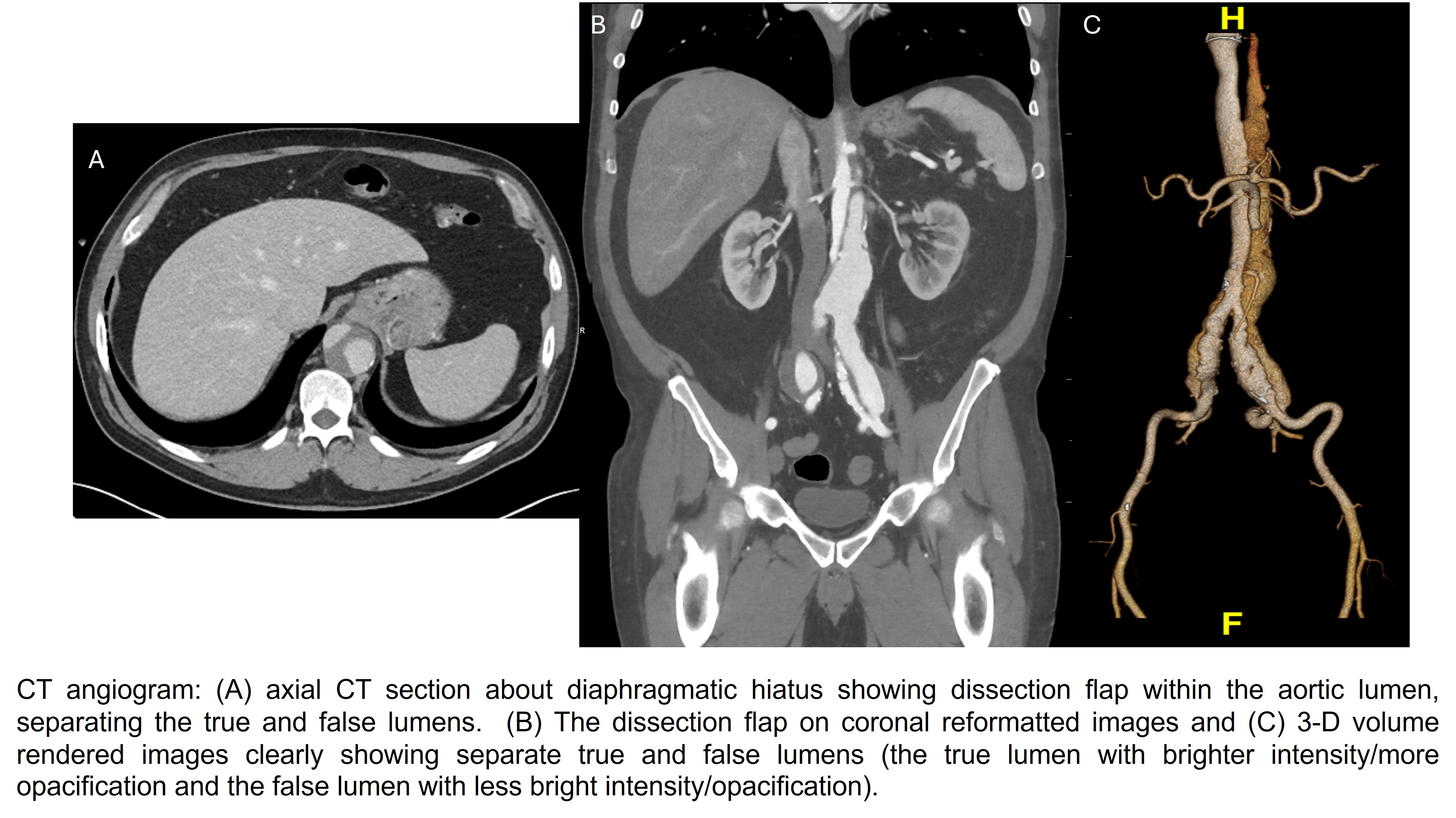<p>Type B Aortic Dissection on Computed Tomography&nbsp;Angiography