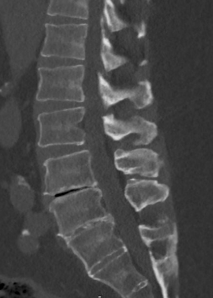 <p>Degenerative Disc Disease with Vacuum Phenomenon