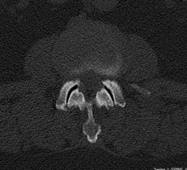 <p>Facet Arthropathy