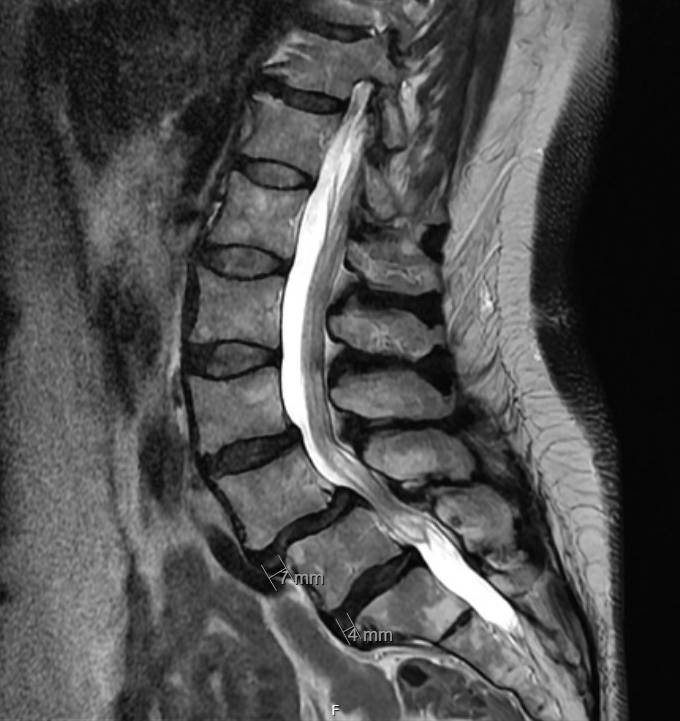 <p>Degenerative Spondylolisthesis with Lumbar Spinal Stenosis