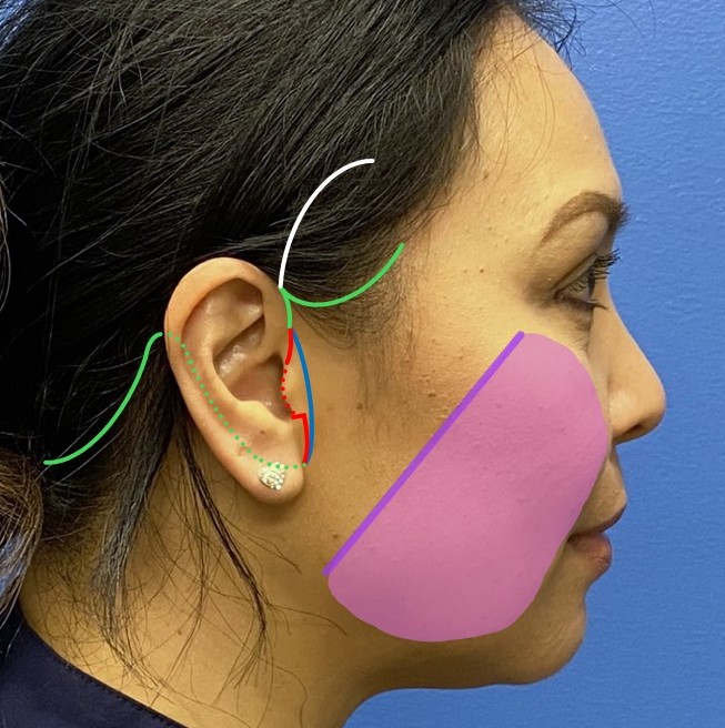 <p>Rhytidectomy Incision Patterns