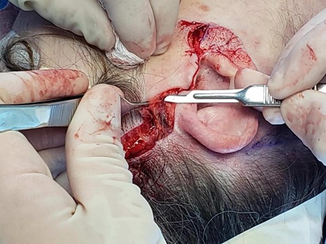 <p>Facial Flap Development