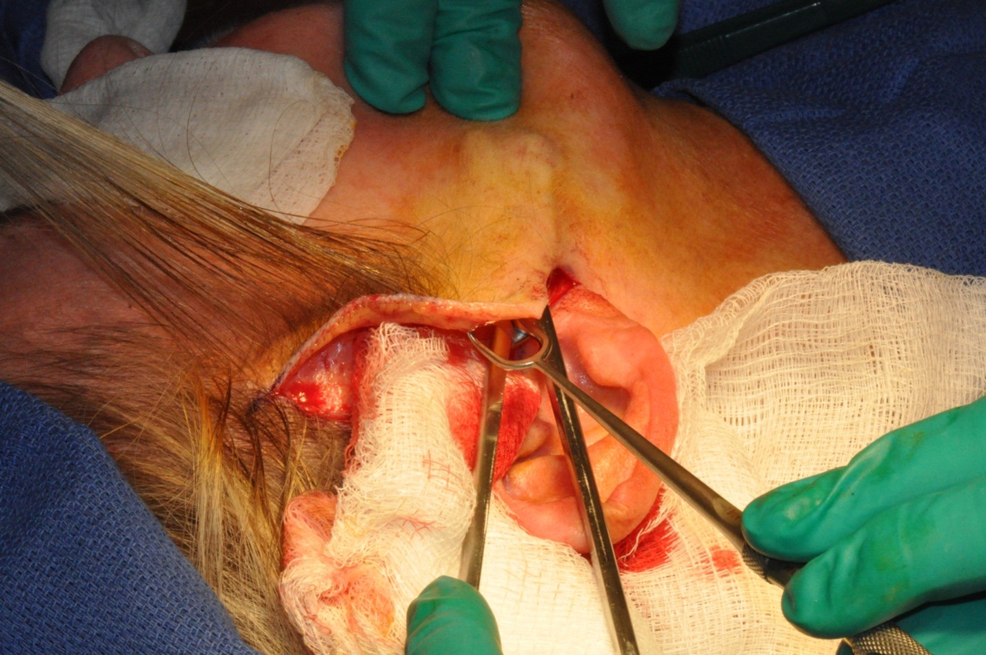 <p>Facial Flap Elevation