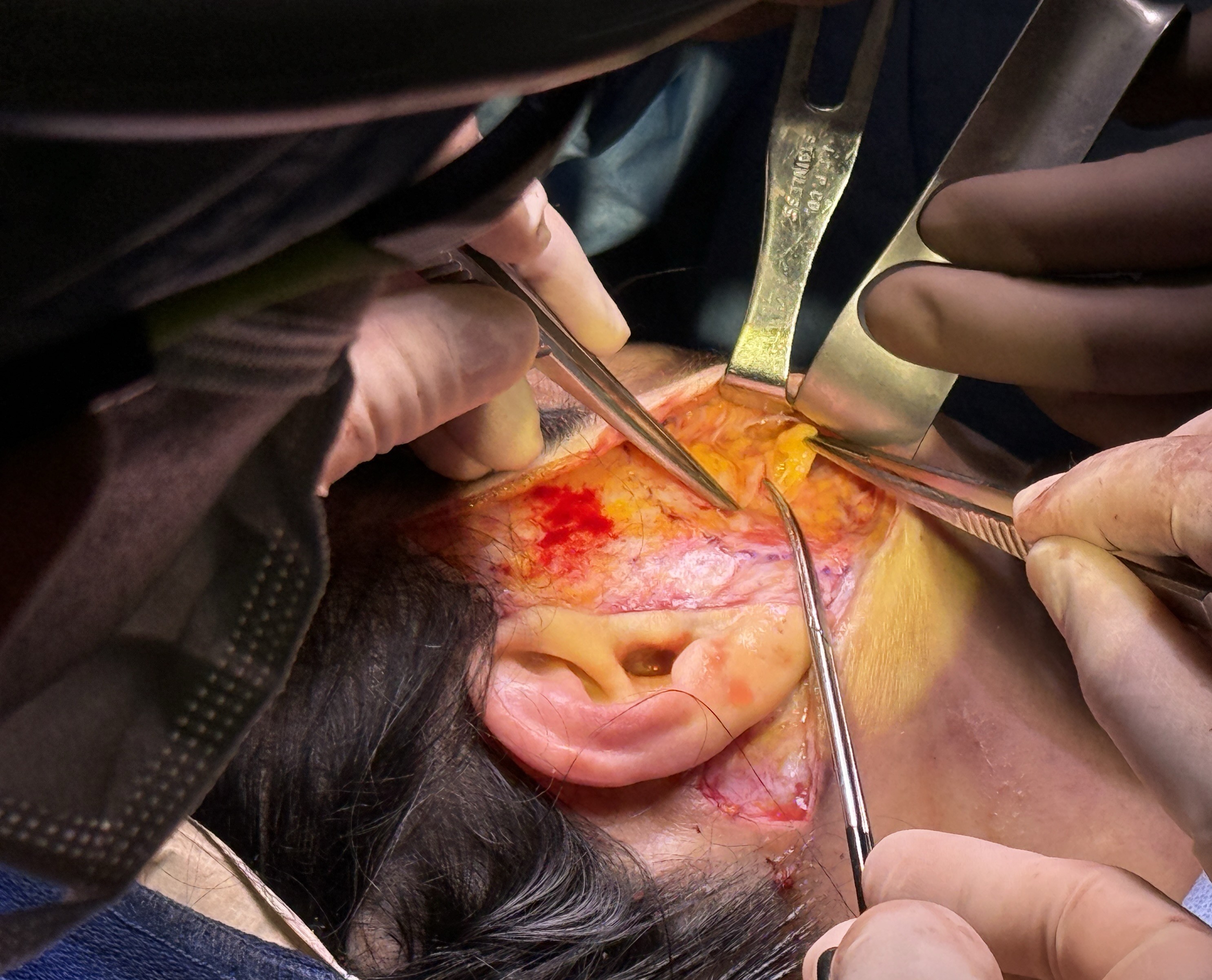 <p>Buccal Fat Pad Reduction