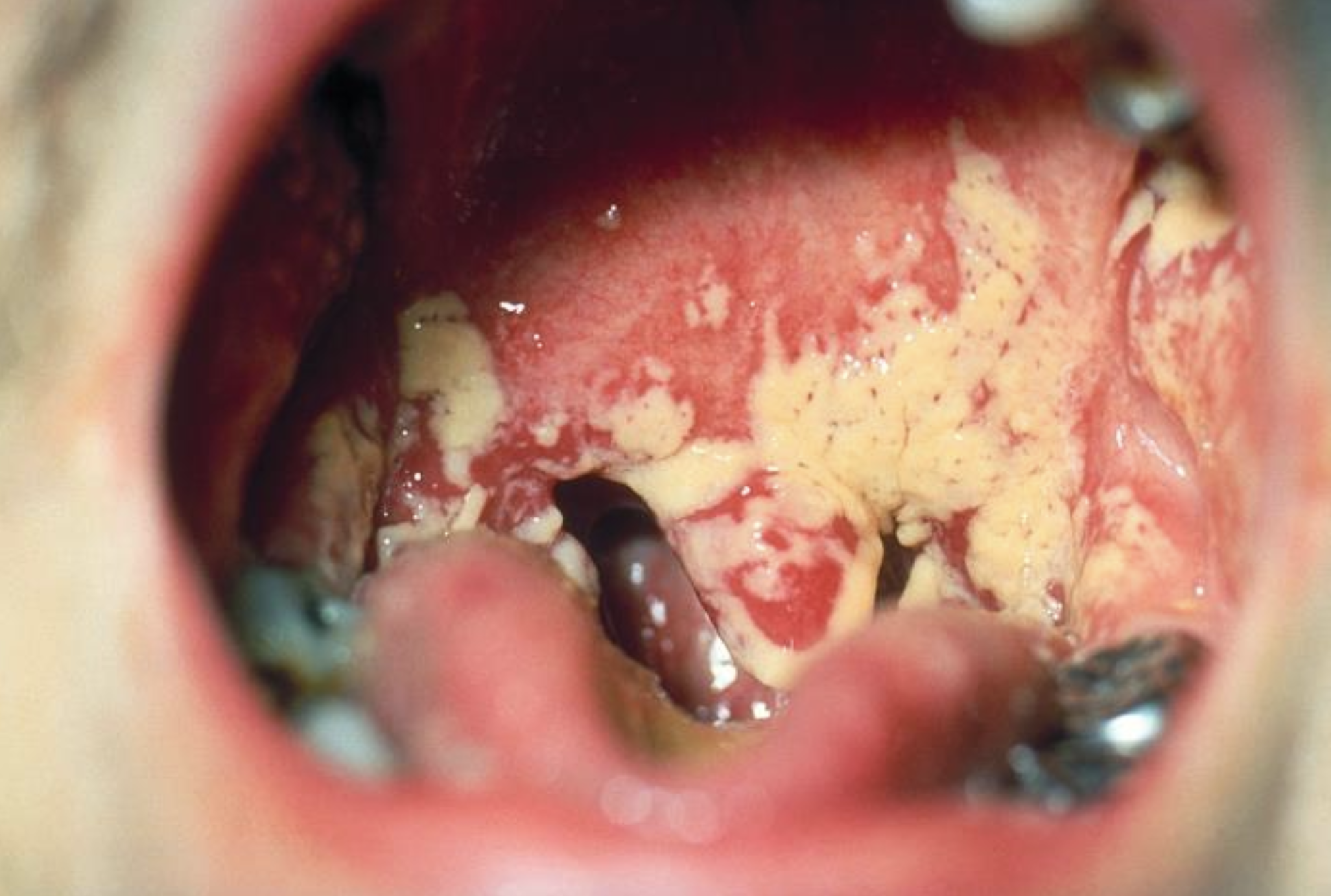 <p>Oropharyngeal Candidiasis