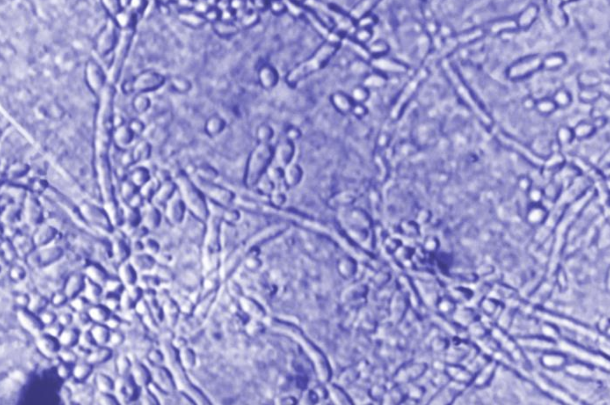 <p><em>Candida</em> Albicans Skin Scraping. Photomicrographic characteristics of the yeast and pseudomycelium forms.</p>