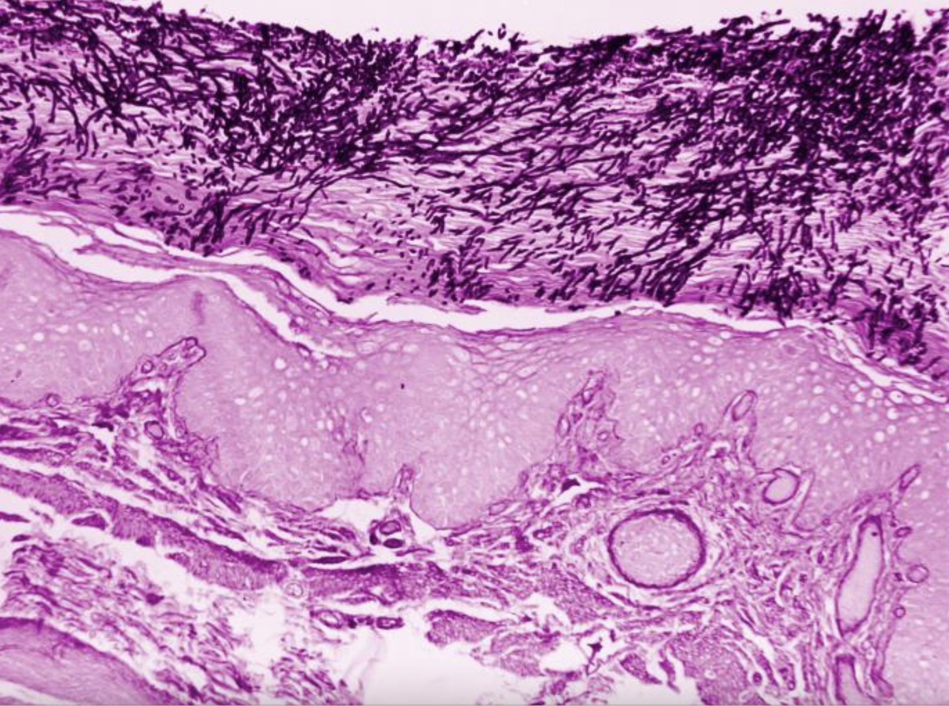 <p><em>Candida</em> Esophagitis Photomicrograph. Histologic findings of esophageal candidiasis.</p>