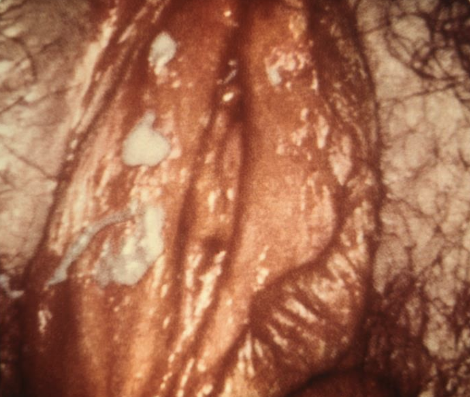 <p>Vulvovaginal <em>Candida</em> Infection. Photomicroscopic features of <em>Candida</em> vulvovaginitis.</p>