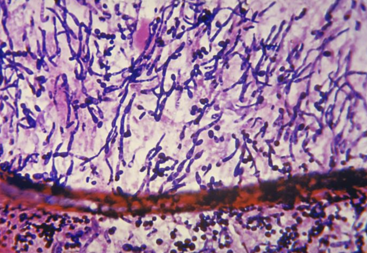 <p><em>Candida</em> Endocarditis. Photomicrographic features of <em>Candida</em> endocarditis.</p>