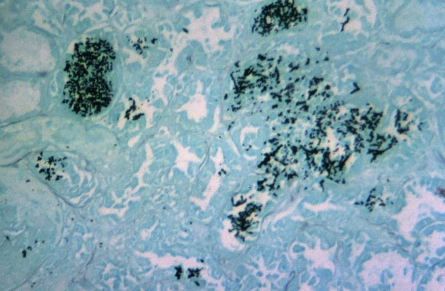 <p>Invasive <em>Candida</em> Infection of the Kidney
