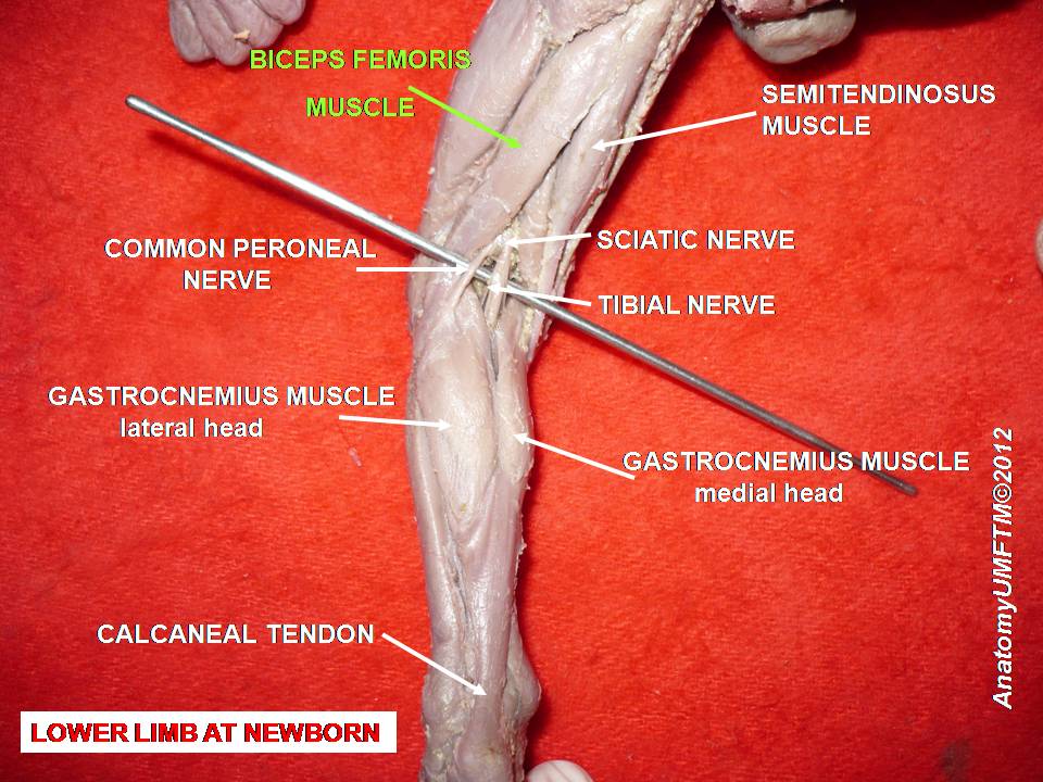 <p>Posterior Thigh Musculature Dissection in a Newborn