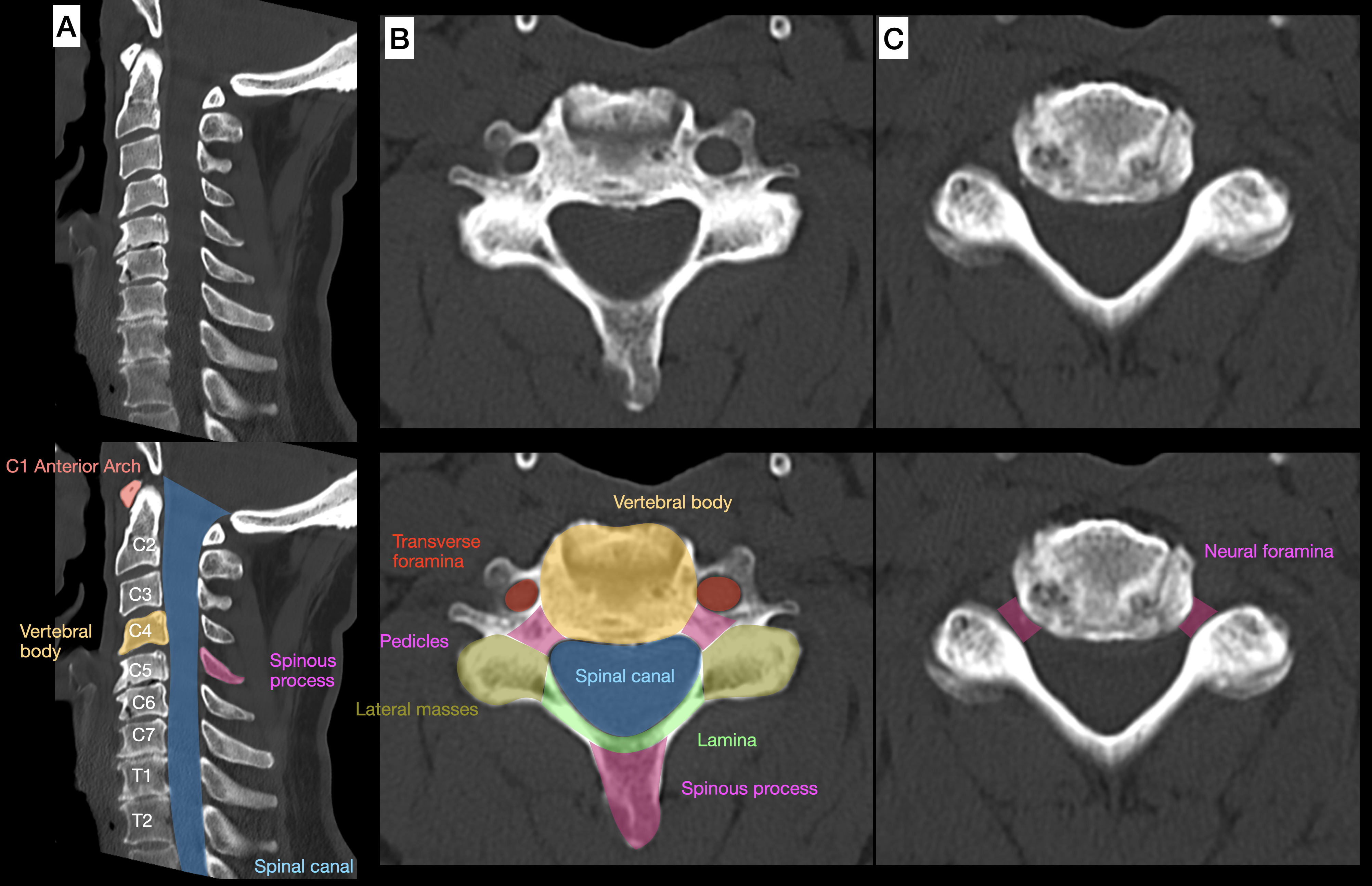 <p>Computed Tomography Anatomy of the Cervical Vertebrae