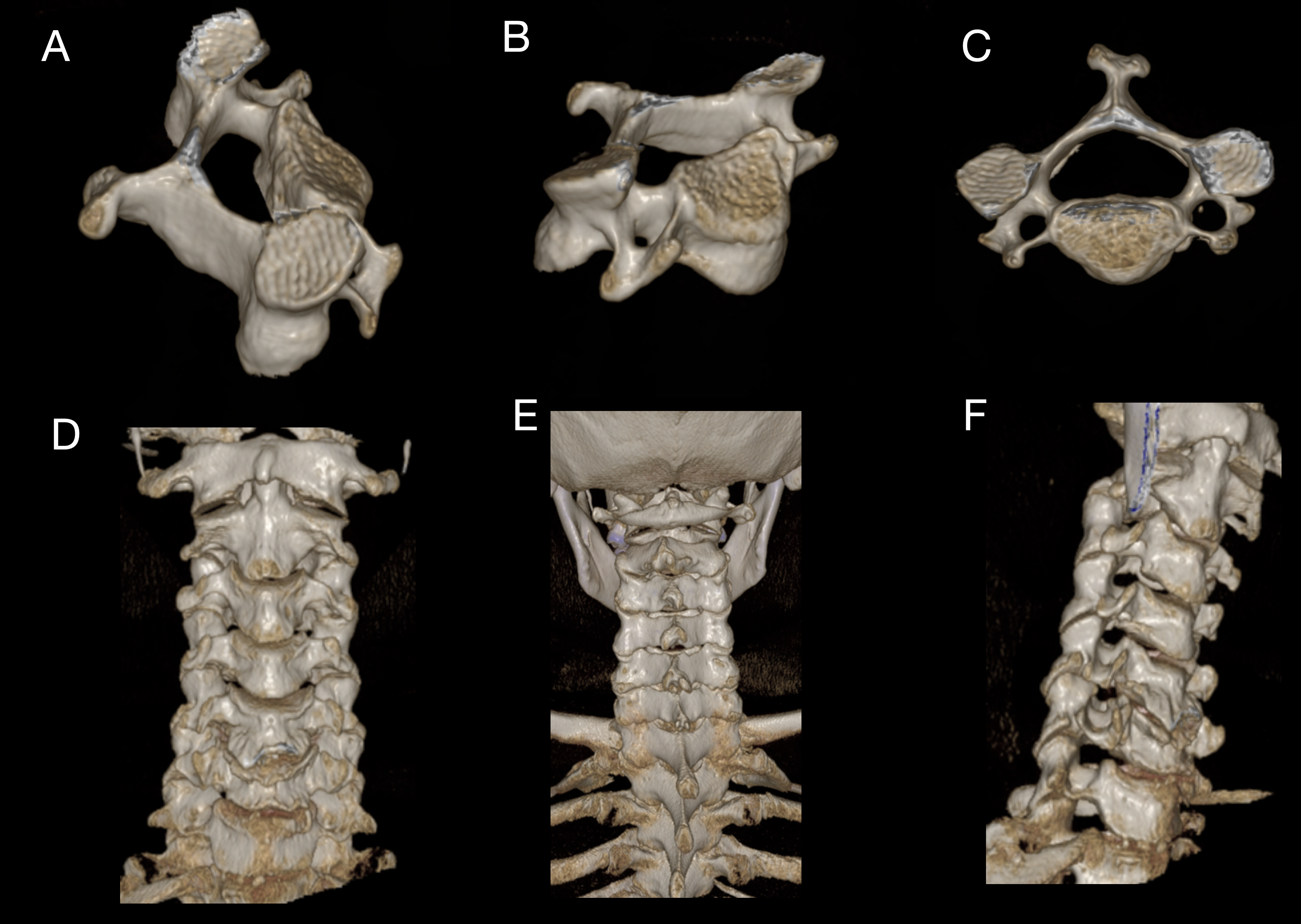 <p>Computed Tomography Anatomy of the Cervical Spine