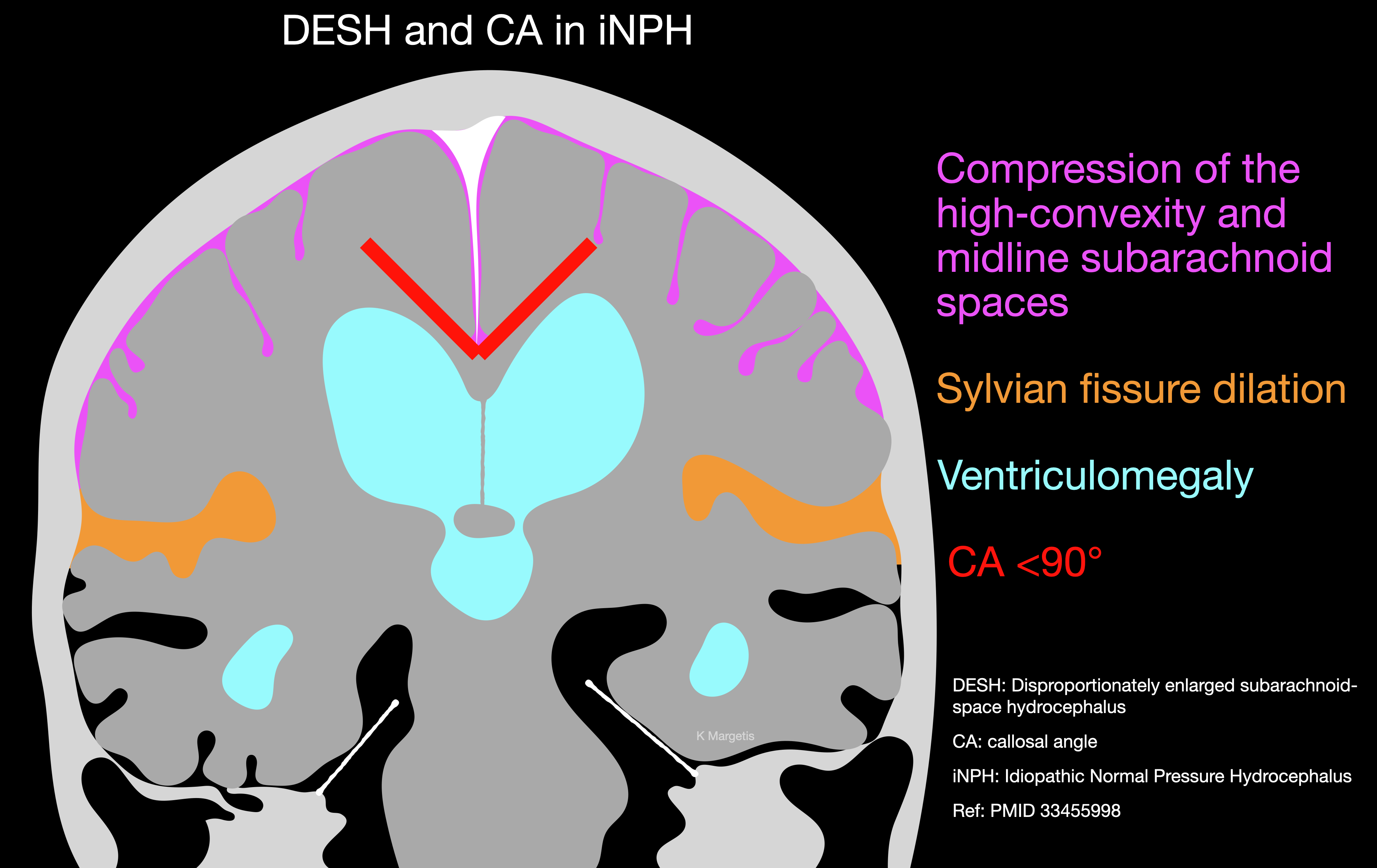 <p>Imaging Hallmarks of Idiopathic Normal Pressure Hydrocephalus