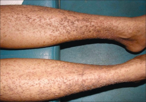<p>Warty Papules on Both Lower Legs in Acrokeratosis Verruciformis of Hopf.</p>