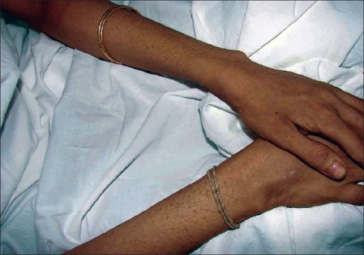 <p>Warty papular lesions hands and forearms due to&nbsp;acrokeratosis verruciformis of Hopf</p>