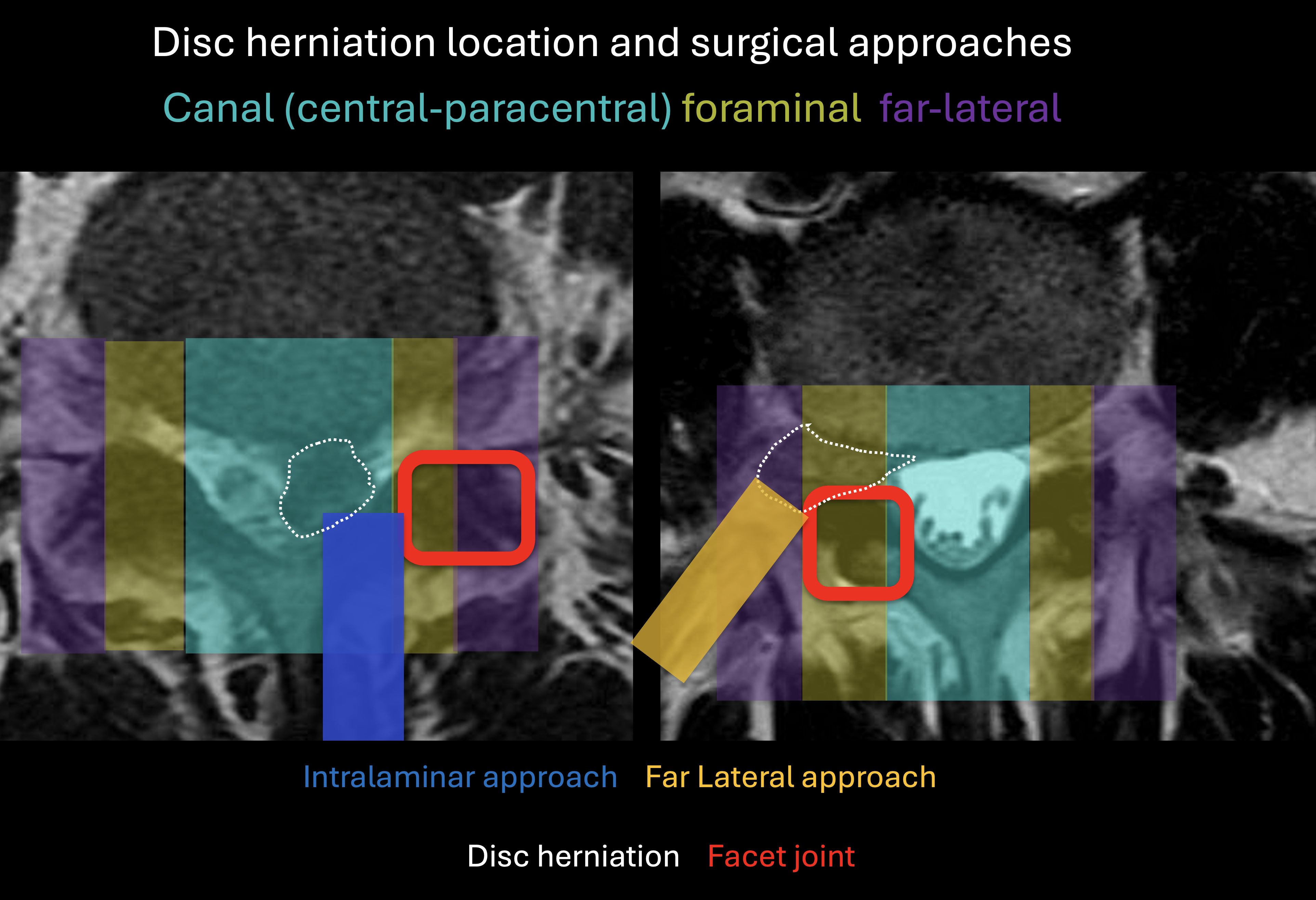 <p>Lumbar Disc Herniation Zones and Surgical Approaches