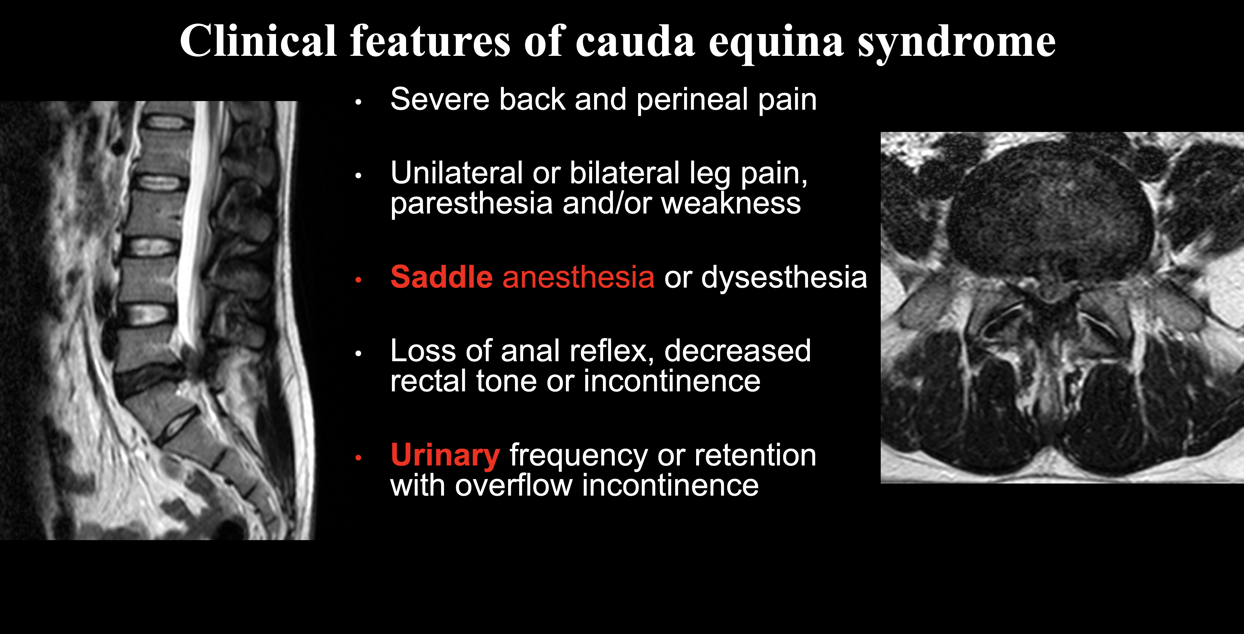<p>Clinical and Radiological Presentation of Cauda Equina Syndrome