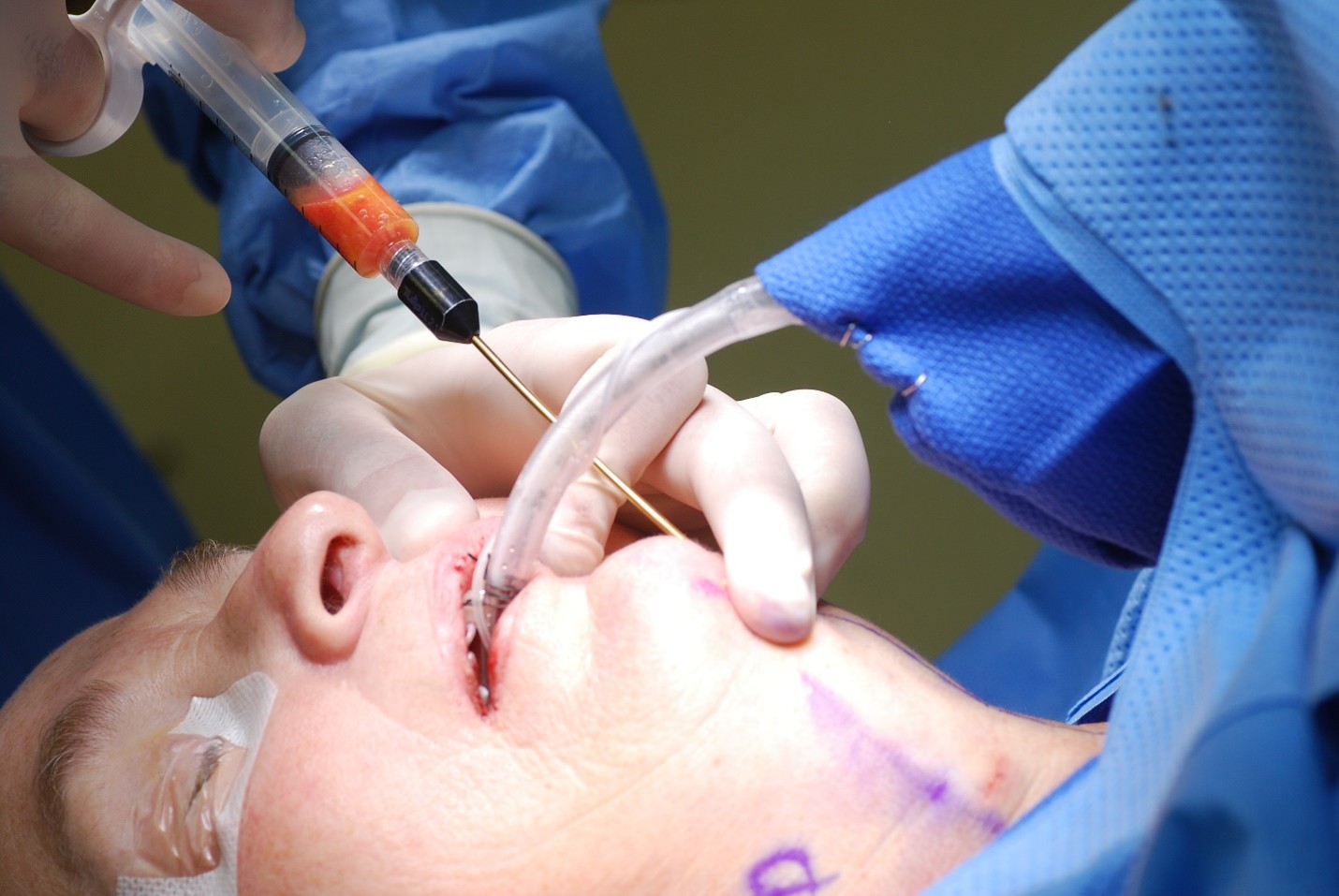 <p>Submental Liposuction