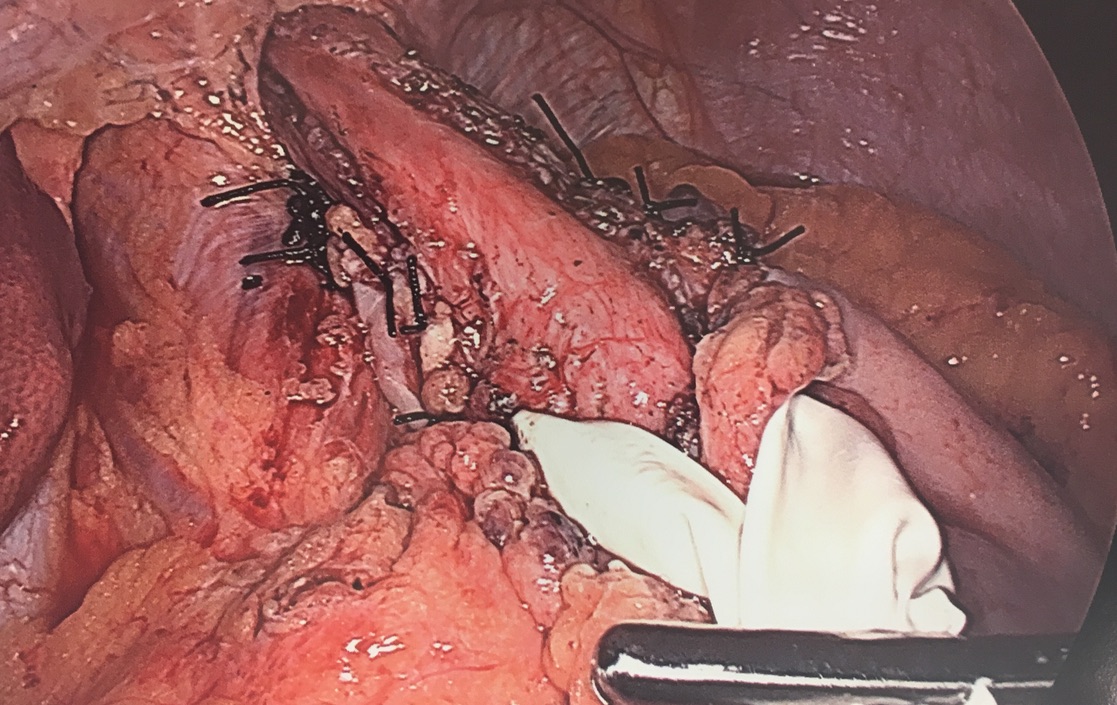 <p>Laparoscopic Heller Myotomy