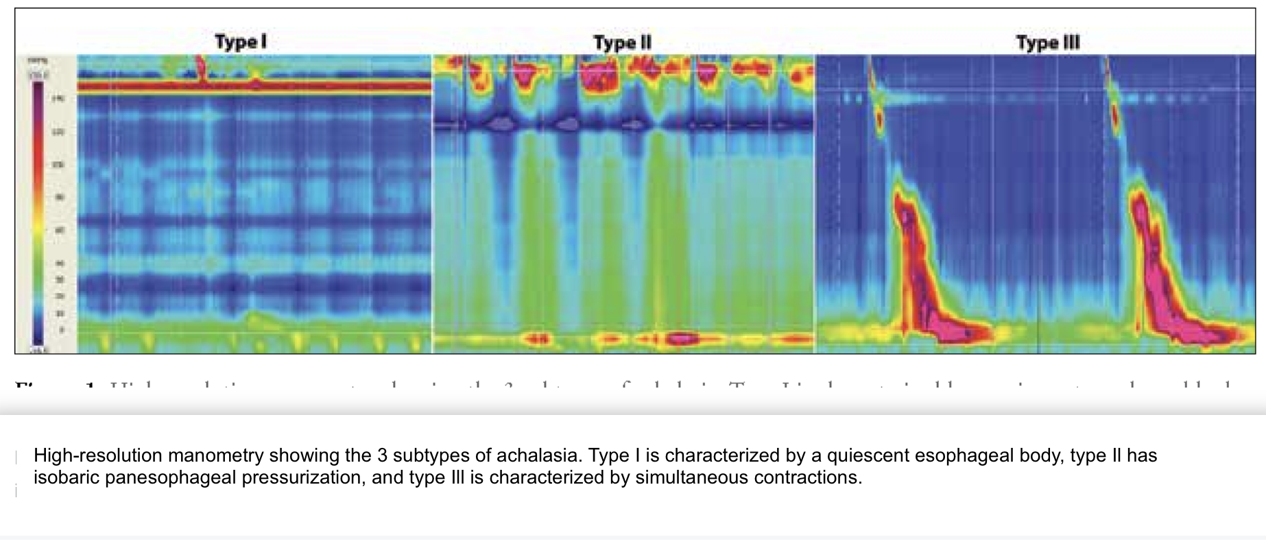 <p>Types of Achalasia. Image of manometry demonstrating types of achalasia.</p>