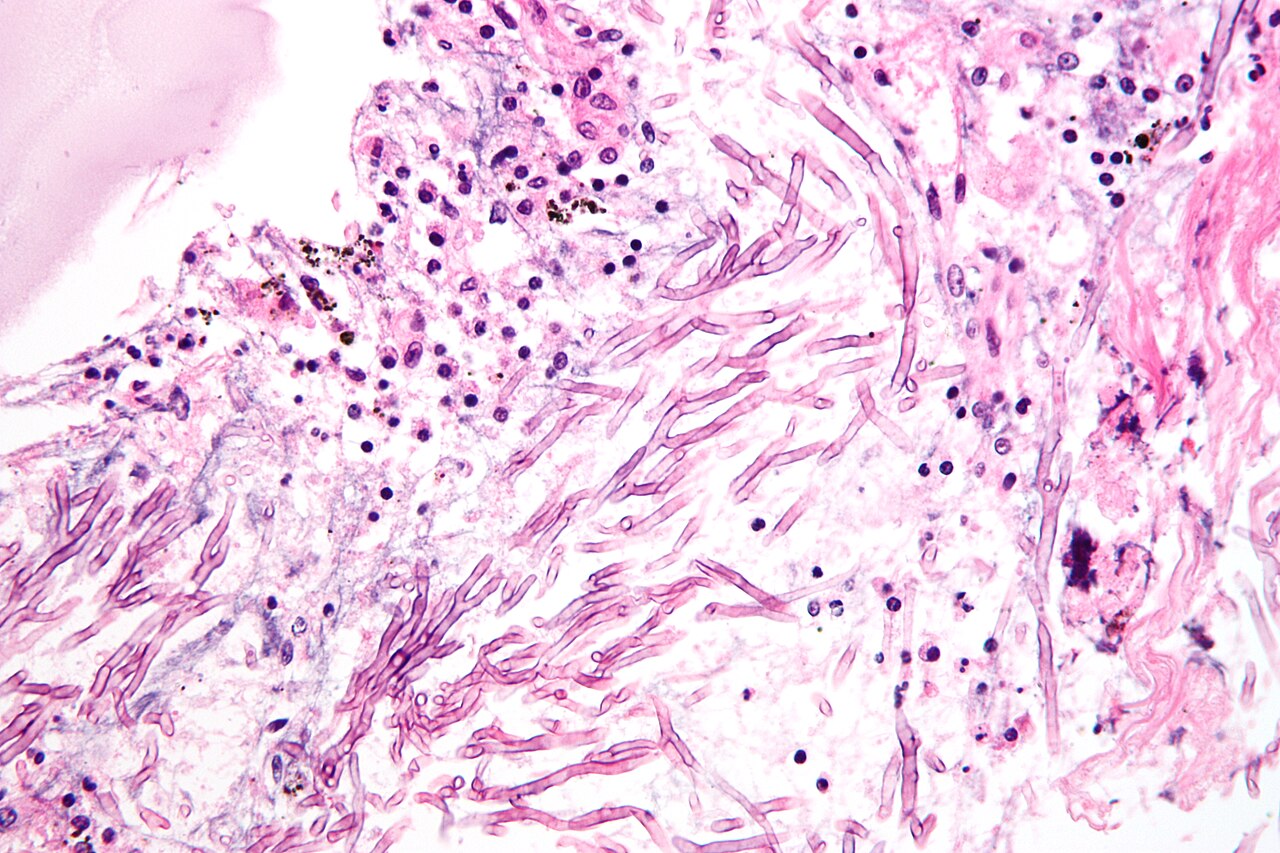 <p><em>Aspergillus</em> Hyphae. Hematoxylin and eosin stain showing uniform septate hyphae with acute-angle branching.</p>