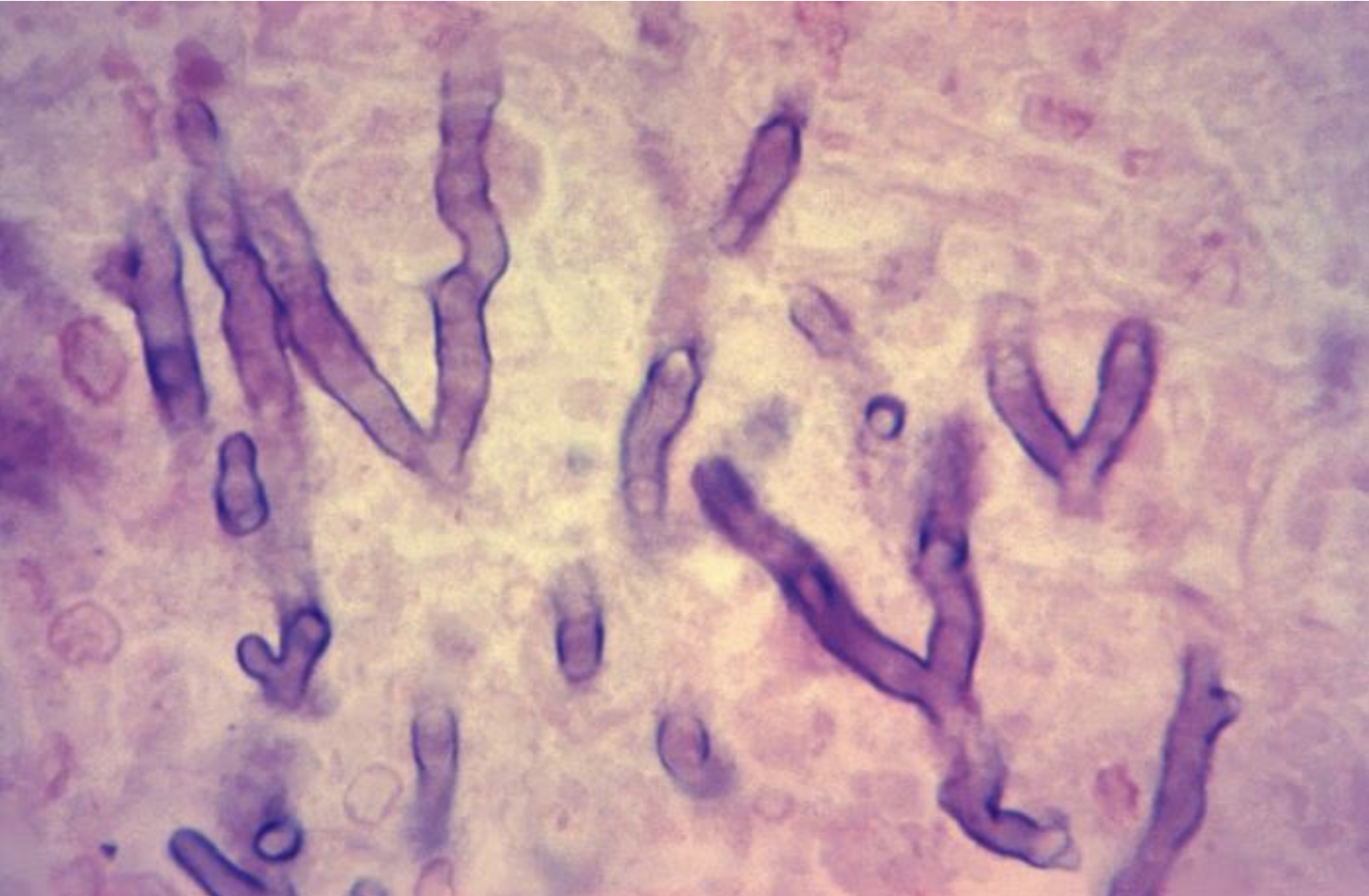 <p>Invasive Pulmonary Aspergilosis