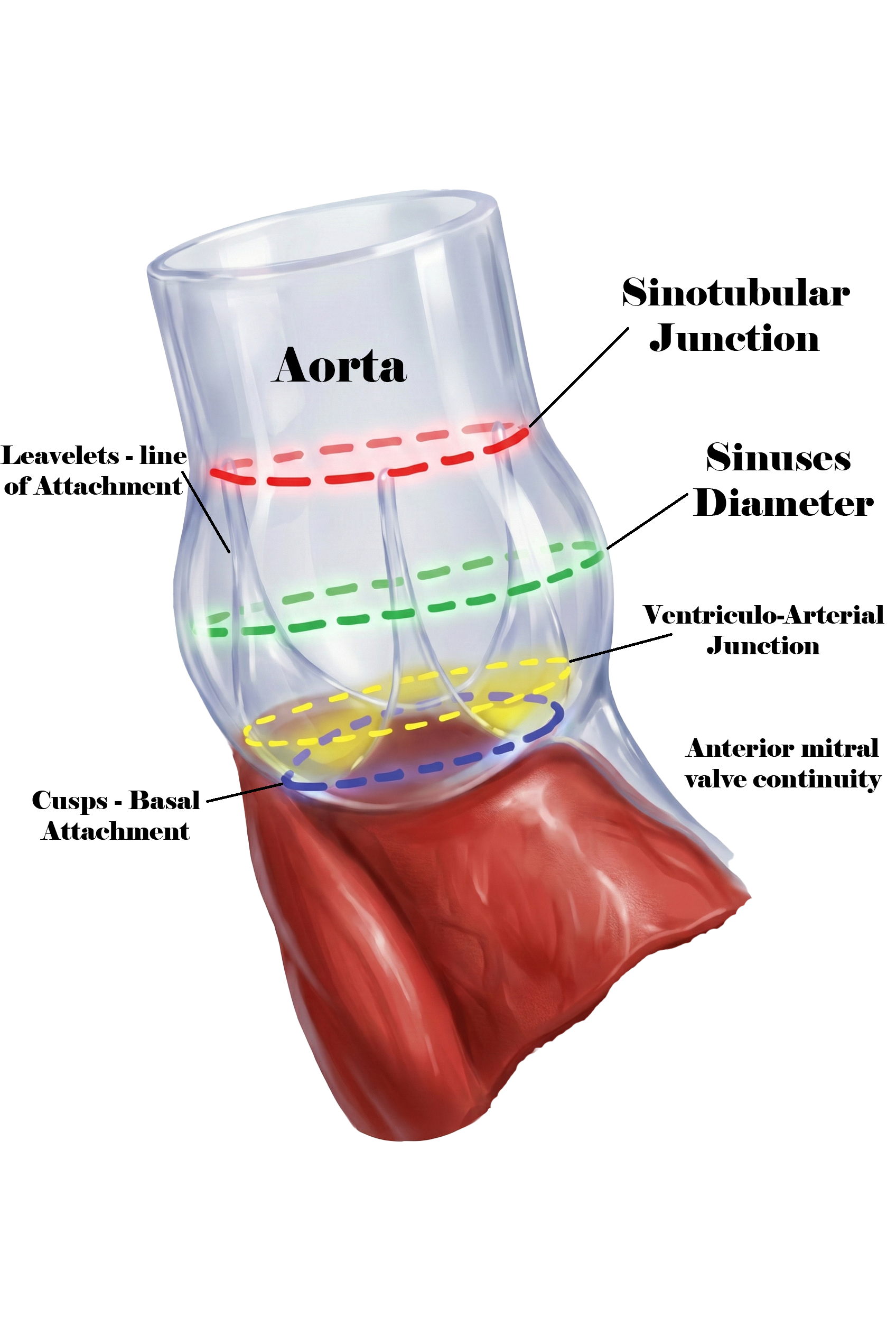<p>Anatomic Landmarks of the Aortic Root