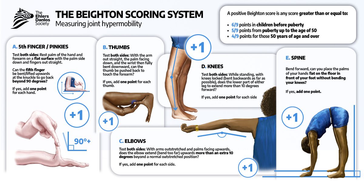 <p>Beighton Scoring System