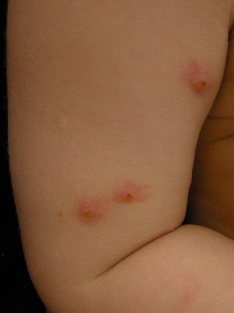 <p>Insect Bites