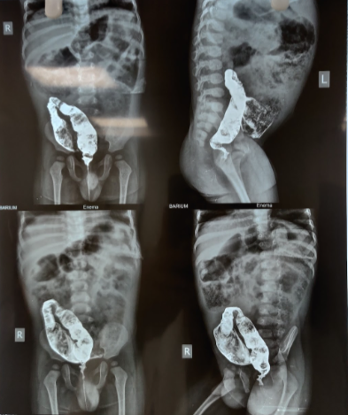 <p>Hirschsprung Disease
