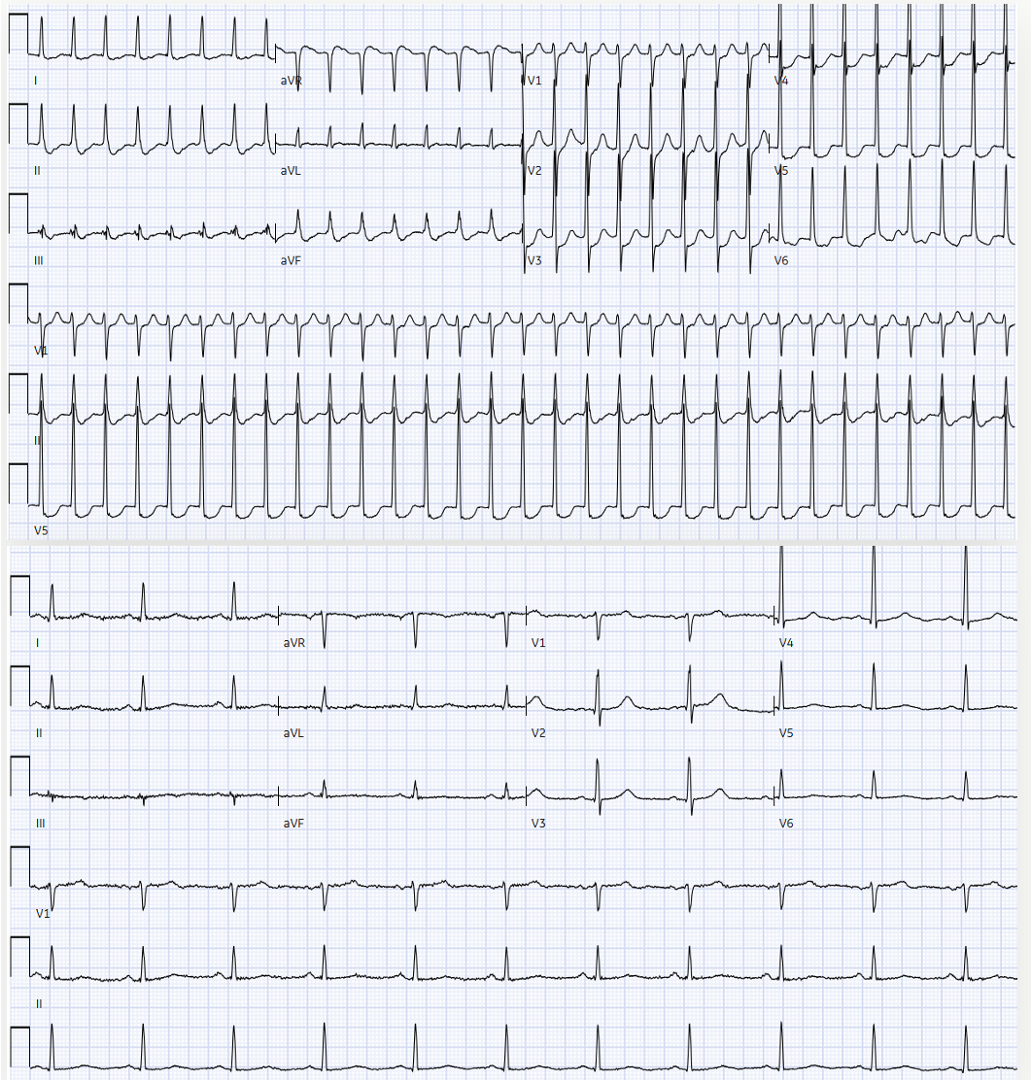 <p>Electrocardiogram of Typical AVNRT With Pseudo-S Waves