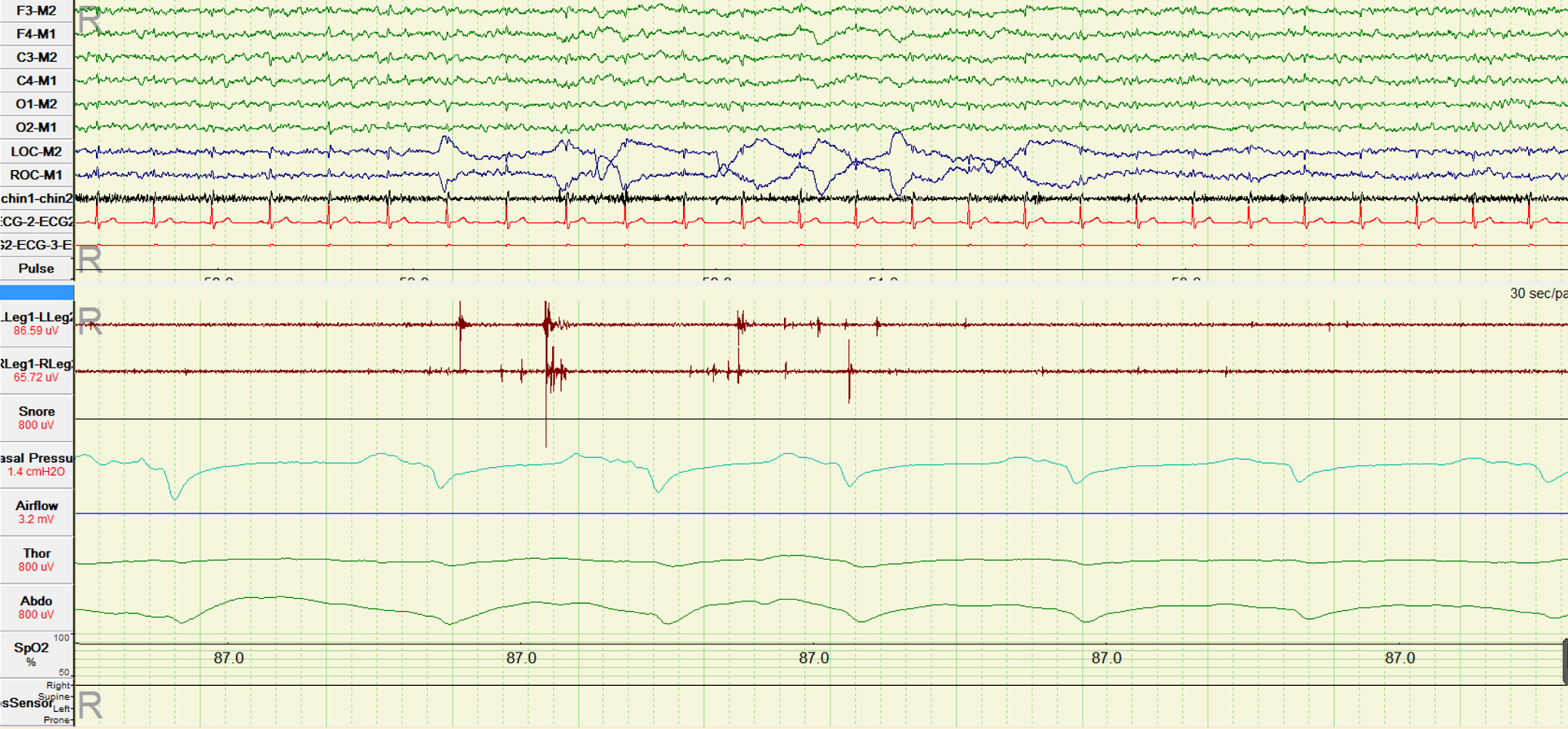 <p>Polysomnogram During Rapid Eye Movement Sleep