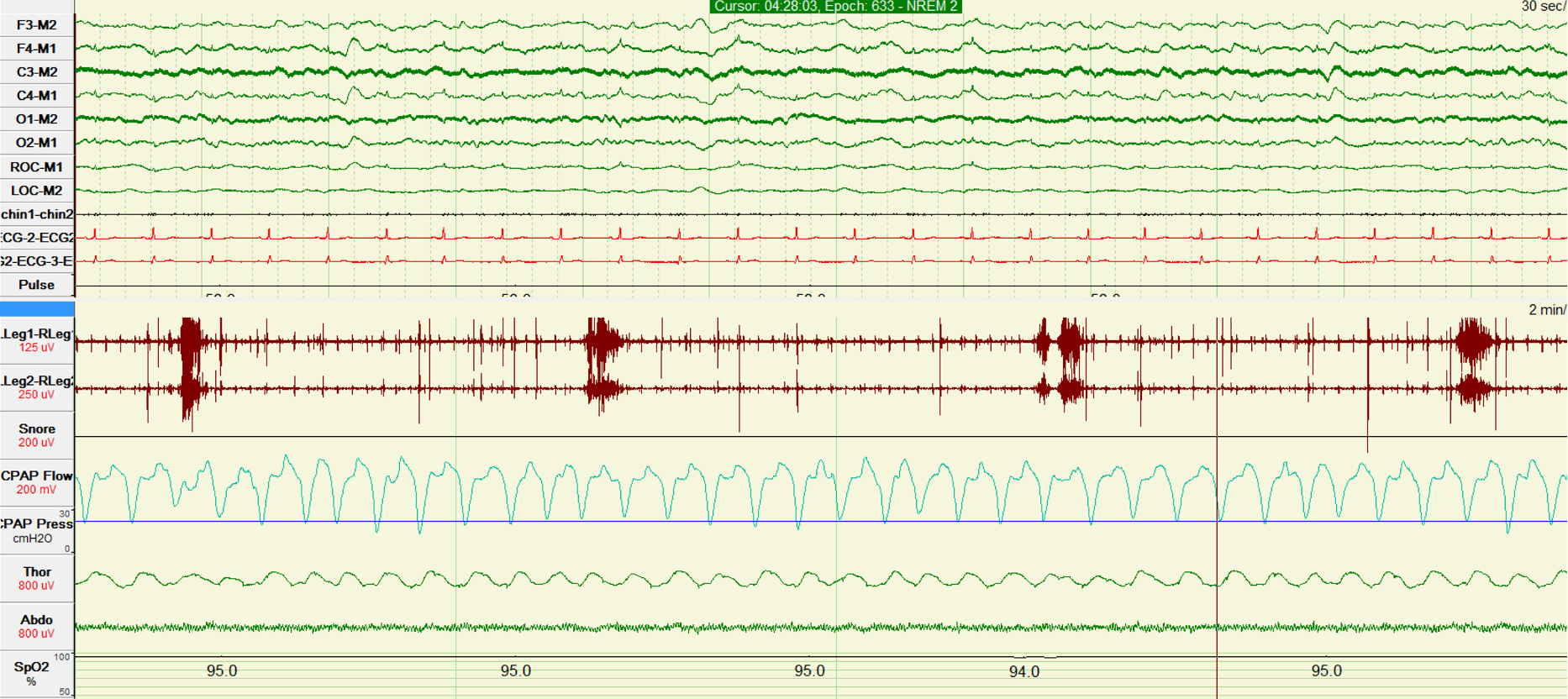 <p>Polysomnogram of Stage N2 Sleep with Periodic Limb Movements