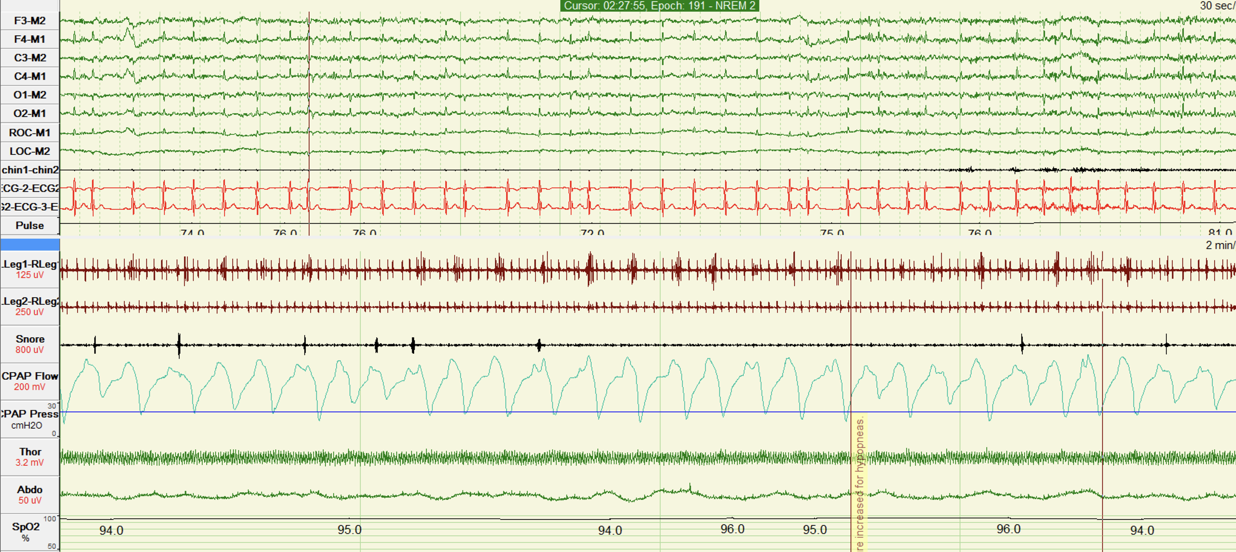 <p>Polysomnogram With Fragmentary Myoclonus in Stage N2 Sleep
